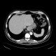 Hiatal hernia: CT - Computed tomography